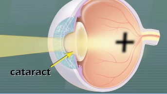 Cataracts  SW Video