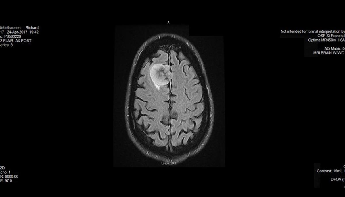 Cancer Brain Tumor Scan Image