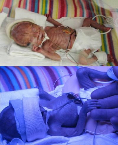 Brynn (top) and Brie are shown on their second day of life.