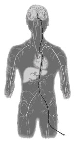 Coil  Embolization Body Graphic 