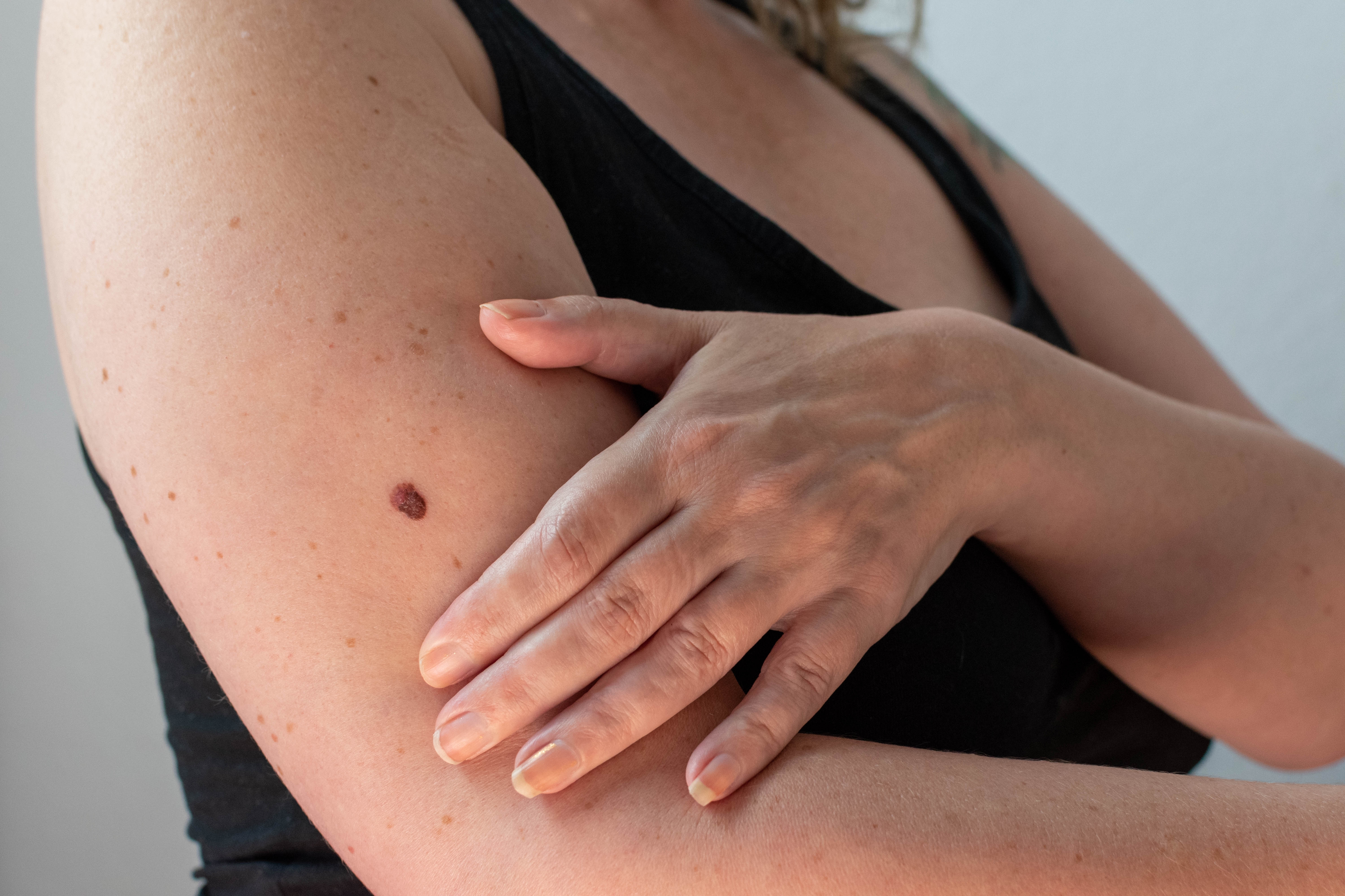 Women with skin cancer on arm