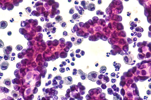 Lung Cancer Cells Blog