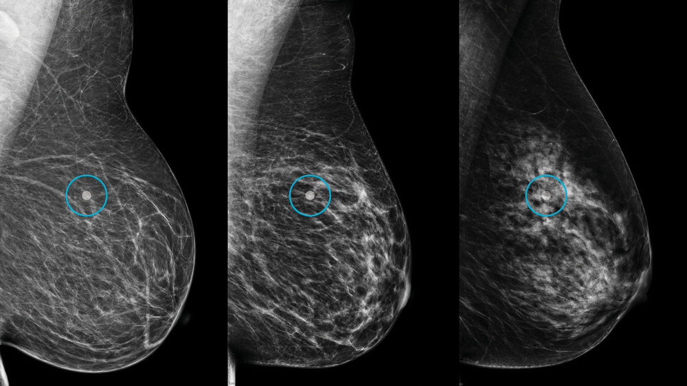 Breast Density Image Results