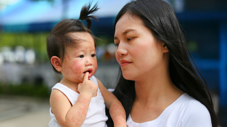 A mother holding her toddler, who has a mild rash on her cheek.