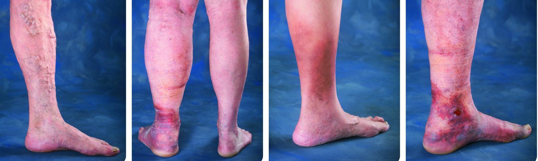 Venous Disease Progression Image