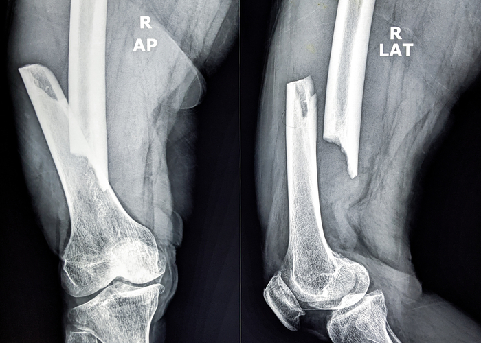 Xray of broken bone