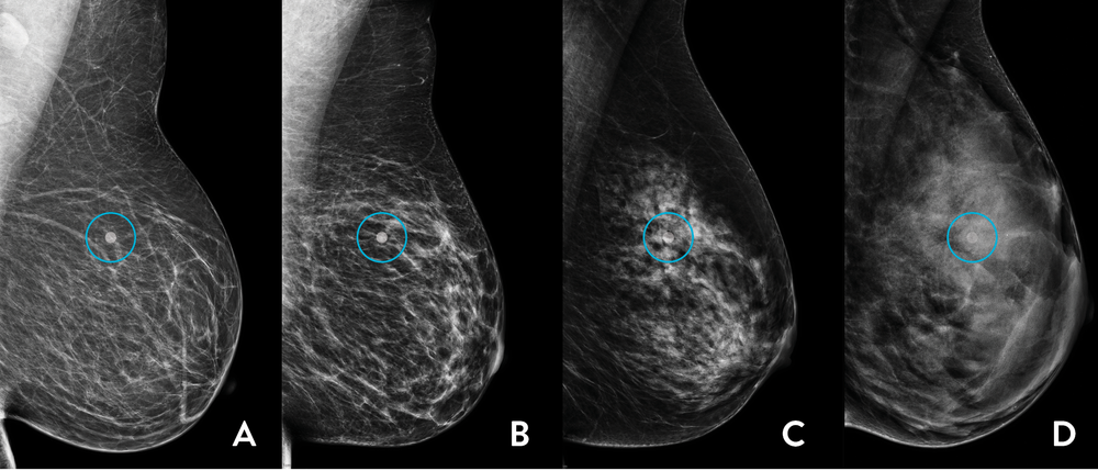 Scans showing four levels of breast density
