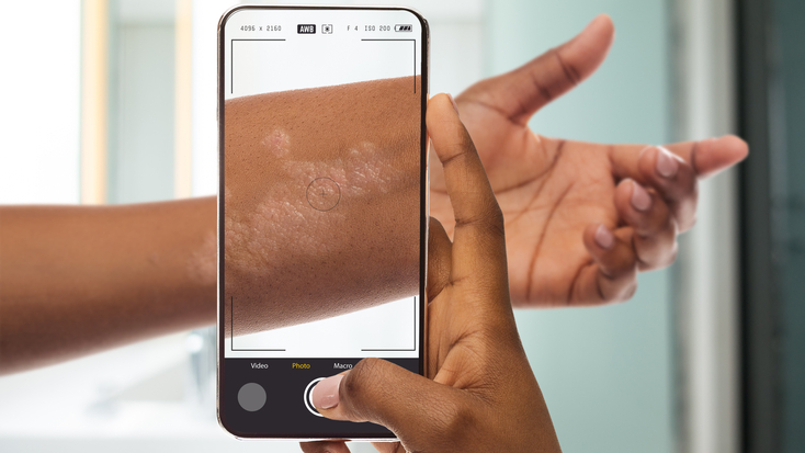 Scanning a rash on the forearm with a phone camera