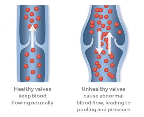 Varicose Veins image