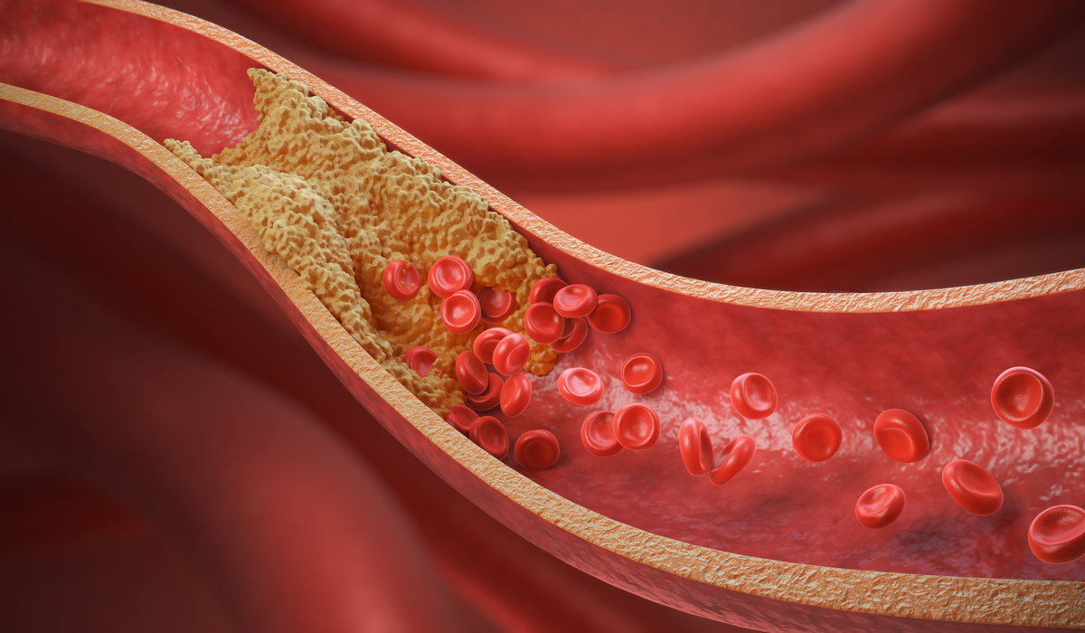 Bloodstream cholesterol