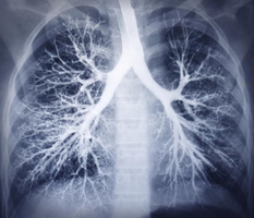 lung-x-ray.jpg__300x200_q100_subject_location-300,259_subsampling-2.jpg